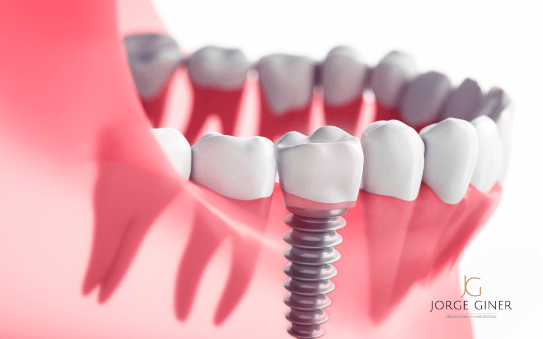 Proceso de colocación de un implante dental